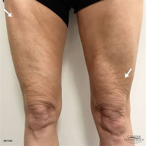 velashape 3 before and after|velashape before and after thighs.
